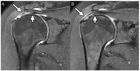 rotator cuff tear mri pattern